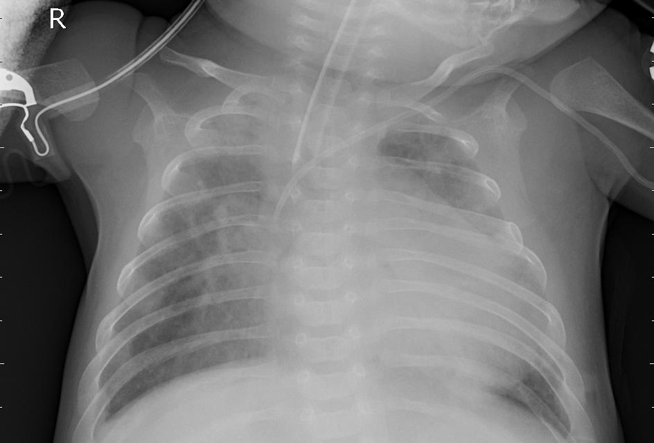 pneumonia_1.jpeg