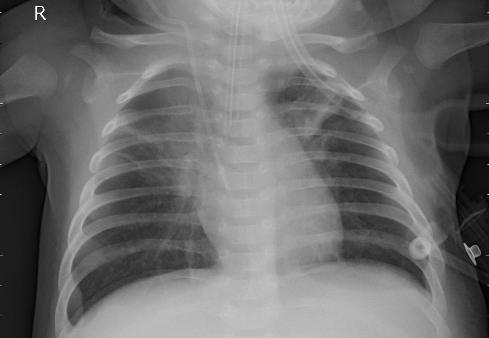 pneumonia_3.jpeg